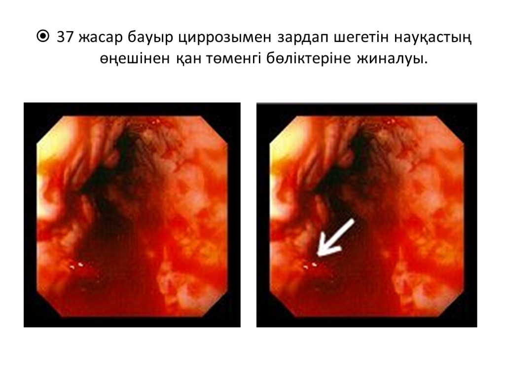 37 жасар бауыр циррозымен зардап шегетін науқастың өңешінен қан төменгі бөліктеріне жиналуы.